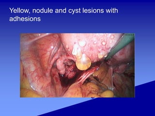 Yellow, nodule and cyst lesions with
adhesions
 