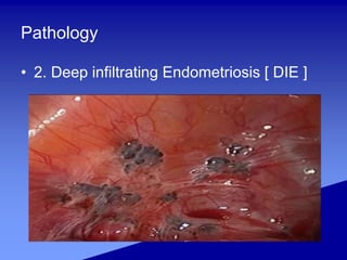 Pathology
• 2. Deep infiltrating Endometriosis [ DIE ]
 