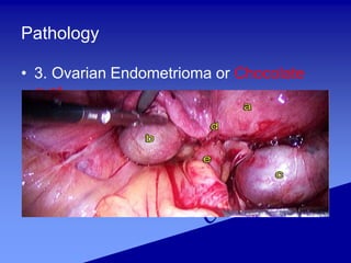 Pathology
• 3. Ovarian Endometrioma or Chocolate
cyst
 