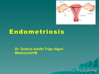 Endometriosis
Dr. Octavio Adolfo Trigo Viguri
Medicina/UVM
 