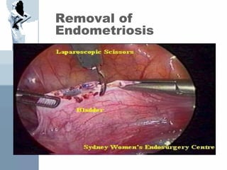 Removal of
Endometriosis
 