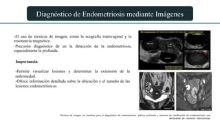 Diagnóstico de Endometriosis mediante Imágenes
-El uso de técnicas de imagen, como la ecografía transvaginal y la
resonancia magnética.
-Precisión diagnóstica de en la detección de la endometriosis,
especialmente la profunda.
Importancia:
-Permite visualizar lesiones y determinar la extensión de la
enfermedad.
-Ofrece información detallada sobre la ubicación y el tamaño de las
lesiones endometriósicas
Técnicas de imagen no invasivas para el diagnóstico de endometriosis pélvica profunda y sistemas de clasificación de endometriosis: una
declaración de consenso internacional.
 