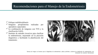 Recomendaciones para el Manejo de la Endometriosis
 Enfoque multidisciplinario
 Imágenes preoperatorias realizadas por
operadores capacitados.
 La combinación de imágenes con TVS y la
clasificación AAGL.
 Sustituto de métodos invasivos para clasificar
la endometriosis, mejorando así la precisión
diagnóstica y facilitando la planificación del
tratamiento.
Técnicas de imagen no invasivas para el diagnóstico de endometriosis pélvica profunda y sistemas de clasificación de endometriosis: una
declaración de consenso internacional.
 