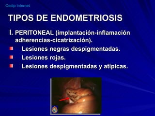TIPOS DE ENDOMETRIOSIS I.  PERITONEAL (implantación-inflamación adherencias-cicatrización). Lesiones negras despigmentadas. Lesiones rojas. Lesiones despigmentadas y atípicas.   
