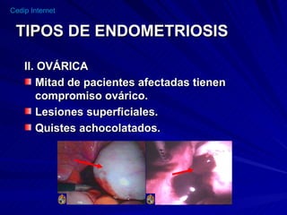 TIPOS DE ENDOMETRIOSIS II. OVÁRICA Mitad de pacientes afectadas tienen  compromiso ovárico. Lesiones superficiales. Quistes achocolatados.    