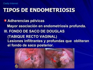 Adherencias pélvicas Mayor asociación en endometriosis profunda. III. FONDO DE SACO DE DOUGLAS (TABIQUE RECTO VAGINAL)  Lesiones infiltrantes y profundas que  obliteran el fondo de saco posterior. TIPOS DE ENDOMETRIOSIS 