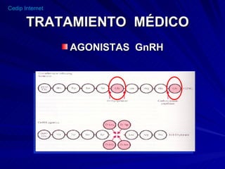 TRATAMIENTO  MÉDICO AGONISTAS  GnRH 