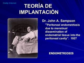 TEORÍA DE  IMPLANTACIÓN Dr. John A. Sampson “ Peritoneal endometriosis  due to menstrual  dissemination of endometrial tissue into the peritoneal cavity”.  1927 ENDOMETRIOSIS 