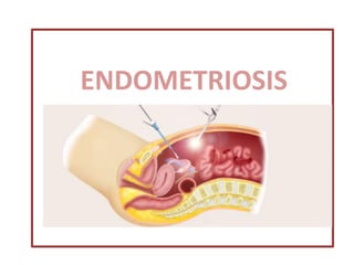 ENDOMETRIOSIS
ENDOMETRIOSIS
 