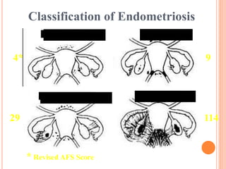 Stage I (Minimal) Stage II (Mild)
Stage III (Moderate) Stage IV (Severe)
Classification of Endometriosis
4* 9
11429
* Revised AFS Score
 