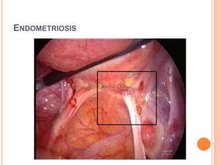 ENDOMETRIOSIS
 