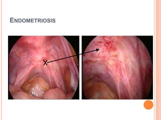 ENDOMETRIOSIS
 