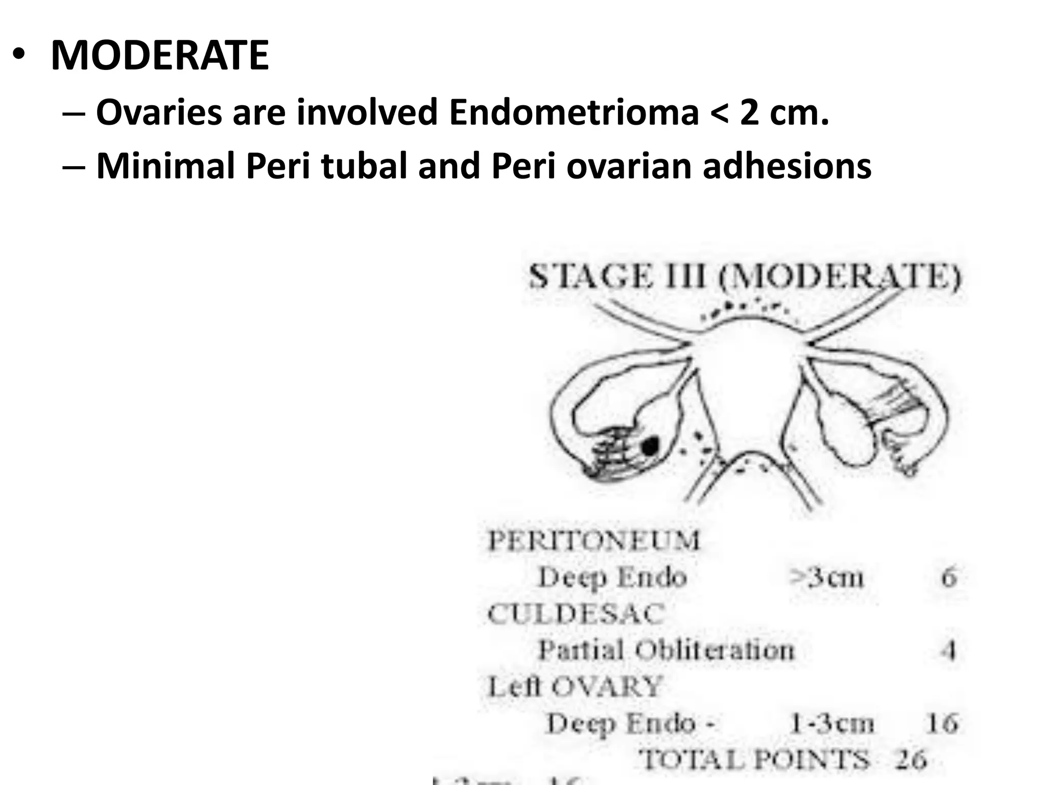 classification of endometriosis/staging/management PPTX