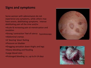 Signs and symptoms 
Some women with adenomyosis do not 
experience any symptoms, while others may 
have severe, debilitating symptoms. Intense 
debilitating pain all the time and/or 
•Acute & increasing pain at menstruation and 
ovulation 
•Strong 'contraction' feel of uterus 
•Abdominal cramps 
•A 'bearing' down feeling 
•Pressure on bladder 
•Dragging sensation down thighs and legs 
•Heavy bleeding and flooding 
•Large blood clots 
•Prolonged bleeding i.e.; up to 8–14 days 
hysrotoscopy 
 