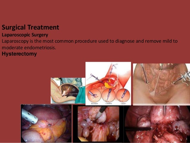 Danazol For Endometriosis Surgery