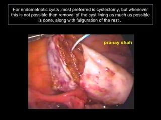 For endometriotic cysts ,most preferred is cystectomy, but whenever
this is not possible then removal of the cyst lining as much as possible
               is done, along with fulguration of the rest .
 