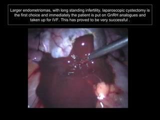 Larger endometriomas, with long standing infertility, laparoscopic cystectomy is
  the first choice and immediately the patient is put on GnRH analogues and
             taken up for IVF. This has proved to be very successful .
 
