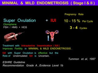 MINIMAL & MILD ENDOMETRIOSIS ( Stage I & II )

                                                Pregnancy Rate

Super Ovulation                   + IUI         10 - 15 %    Per Cycle
Clomiphene
FSH / HMG + HCG                                    3-4     Cycles




Treatment with Intrauterine Insemination ( IUI )
Improves Fertility in MINIMAL & MILD ENDOMETRIOSIS .
IUI with Super Ovulation is effective but the
Role of Unstimulated IUI is Uncertain.
                                                  Tummon et. al, 1997
ESHRE Guideline
Recommendation Grade A , Evidence Level 1b
 