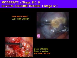 MODERATE ( Stage III ) &
SEVERE ENDOMETRIOSIS ( Stage IV )


     ENDOMETRIOMA
     Cyst Wall Excision




                          Deep Infiltrating
                          Recto - Vaginal
                          ENDOMETRIOSIS
 