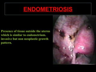 ENDOMETRIOSIS


Presence of tissue outside the uterus
which is similar to endometrium.
invasive but non neoplastic growth
pattern.
 