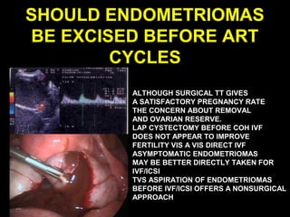 SHOULD ENDOMETRIOMAS
BE EXCISED BEFORE ART
        CYCLES
         ALTHOUGH SURGICAL TT GIVES
         A SATISFACTORY PREGNANCY RATE
         THE CONCERN ABOUT REMOVAL
         AND OVARIAN RESERVE.
         LAP CYSTECTOMY BEFORE COH IVF
         DOES NOT APPEAR TO IMPROVE
         FERTILITY VIS A VIS DIRECT IVF
         ASYMPTOMATIC ENDOMETRIOMAS
         MAY BE BETTER DIRECTLY TAKEN FOR
         IVF/ICSI
         TVS ASPIRATION OF ENDOMETRIOMAS
         BEFORE IVF/ICSI OFFERS A NONSURGICAL
         APPROACH
 