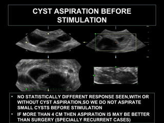 CYST ASPIRATION BEFORE
               STIMULATION




•   NO STATISTICALLY DIFFERENT RESPONSE SEEN,WITH OR
    WITHOUT CYST ASPIRATION,SO WE DO NOT ASPIRATE
    SMALL CYSTS BEFORE STIMULATION
•   IF MORE THAN 4 CM THEN ASPIRATION IS MAY BE BETTER
    THAN SURGERY (SPECIALLY RECURRENT CASES)
 
