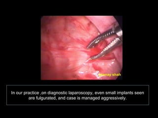 In our practice ,on diagnostic laparoscopy, even small implants seen
         are fulgurated, and case is managed aggressively.
 