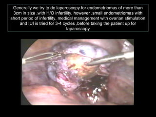 Generally we try to do laparoscopy for endometriomas of more than
 3cm in size ,with H/O infertility, however ,small endometriomas with
short period of infertility, medical management with ovarian stimulation
     and IUI is tried for 3-4 cycles ,before taking the patient up for
                                laparoscopy
 