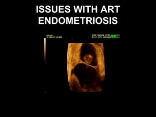 ISSUES WITH ART
 ENDOMETRIOSIS
 