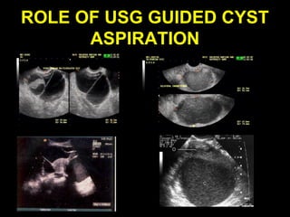 ROLE OF USG GUIDED CYST
      ASPIRATION
 