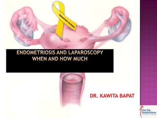 Endometriosis and laparoscopy when and how much  DR. KAWITA BAPAT     