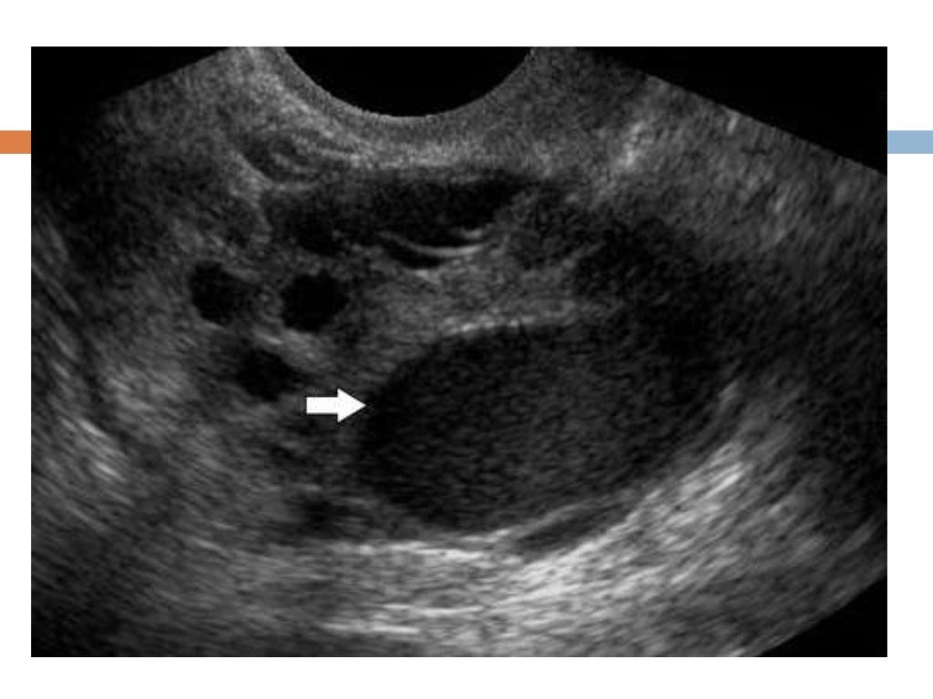 endometriosis-by-ultrasound