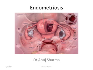 Endometriosis
Dr Anuj Sharma
4/6/2022 Dr Anuj Sharma
 