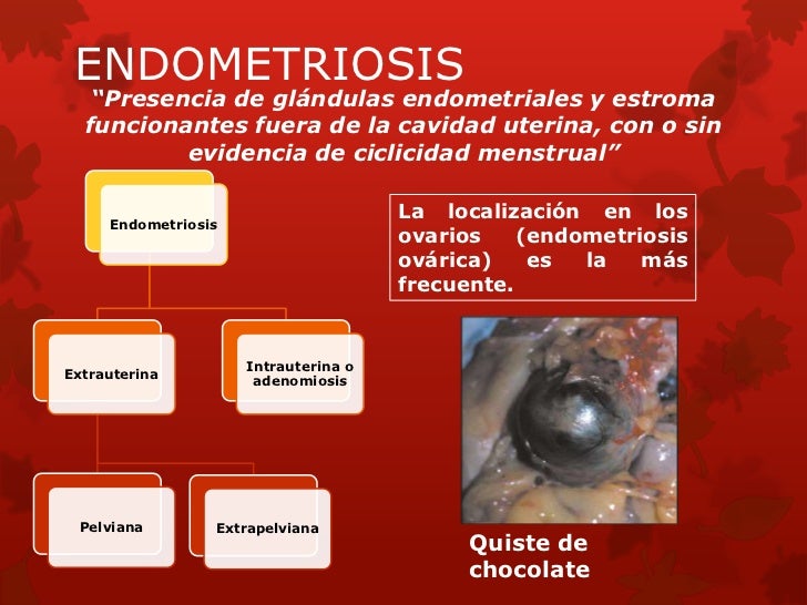 Endometriosis 8581