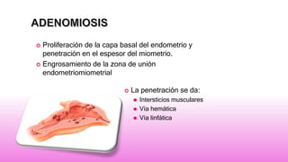  Proliferación de la capa basal del endometrio y
penetración en el espesor del miometrio.
 Engrosamiento de la zona de unión
endometriomiometrial
 La penetración se da:
⚫ Intersticios musculares
⚫ Vía hemática
⚫ Vía linfática
 