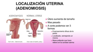  Útero aumenta de tamaño
 Mas pesado
 A corte podemos ver 3
formas
 Engrosamiento difuso de la
pared
 Localizado, semejando un
mioma
 Masa polipode que hace
relieve en la cavidad uterina
 