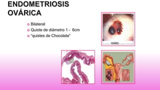  Bilateral
 Quiste de diámetro 1 – 6cm
 “quistes de Chocolate”
 
