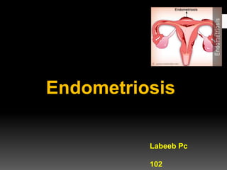 Endometriosis
Labeeb Pc
102
 