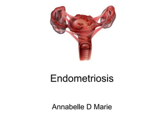 Endometriosis
Annabelle D Marie
 