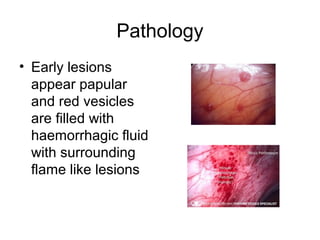 Pathology
• Early lesions
appear papular
and red vesicles
are filled with
haemorrhagic fluid
with surrounding
flame like lesions
 