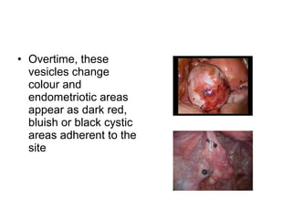 • Overtime, these
vesicles change
colour and
endometriotic areas
appear as dark red,
bluish or black cystic
areas adherent to the
site
 