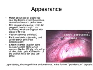 Appearance
• Match stick head or blackened
spot like lesions oveer the ovaries,
serosal surface and peritoneum
• Red implants (petechial, vesicular,
polypoid, haemorrhagic , red
flamelike) which are atypical with
areas of fibrosis
• Vesicles (serous and clear)
• Peritoneal defects (scarring and
yellow brown peritoneal
discolouration)
• Endometriomas (ovarian cysts
containing stale blood which
appears like tar. Widely referred to
as chocolate cysts. Obliteration of
the ovarian fissa can slso taje
place
Laparoscopy, showing minimal endometriosis, in the form of " powder-burn" deposits.
 