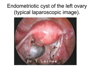 Endometriotic cyst of the left ovary
(typical laparoscopic image).
 