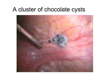 A cluster of chocolate cysts
 