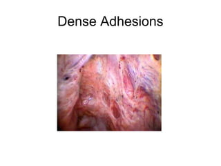 Dense Adhesions
 
