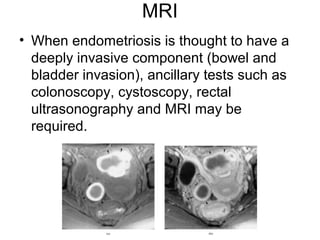 MRI
• When endometriosis is thought to have a
deeply invasive component (bowel and
bladder invasion), ancillary tests such as
colonoscopy, cystoscopy, rectal
ultrasonography and MRI may be
required.
 