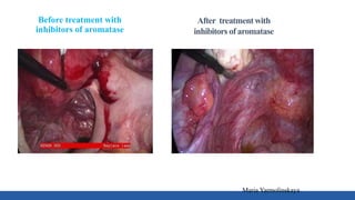 Before treatment with
inhibitors of aromatase
Maria Yarmolinskaya
After treatment with
inhibitors of aromatase
 