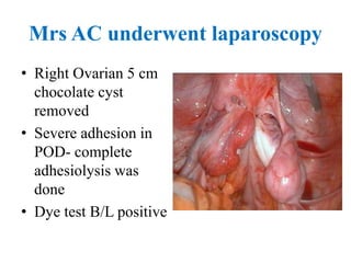 Mrs AC underwent laparoscopy
• Right Ovarian 5 cm
chocolate cyst
removed
• Severe adhesion in
POD- complete
adhesiolysis was
done
• Dye test B/L positive
 