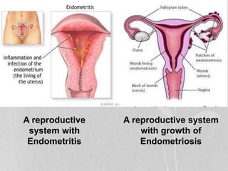 A reproductive
system with
Endometritis
A reproductive system
with growth of
Endometriosis
 