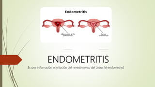 ENDOMETRITIS
Es una inflamación o irritación del revestimiento del útero (el endometrio)
 